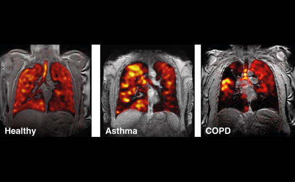 3 images of MRI scans of lungs at different levels of health